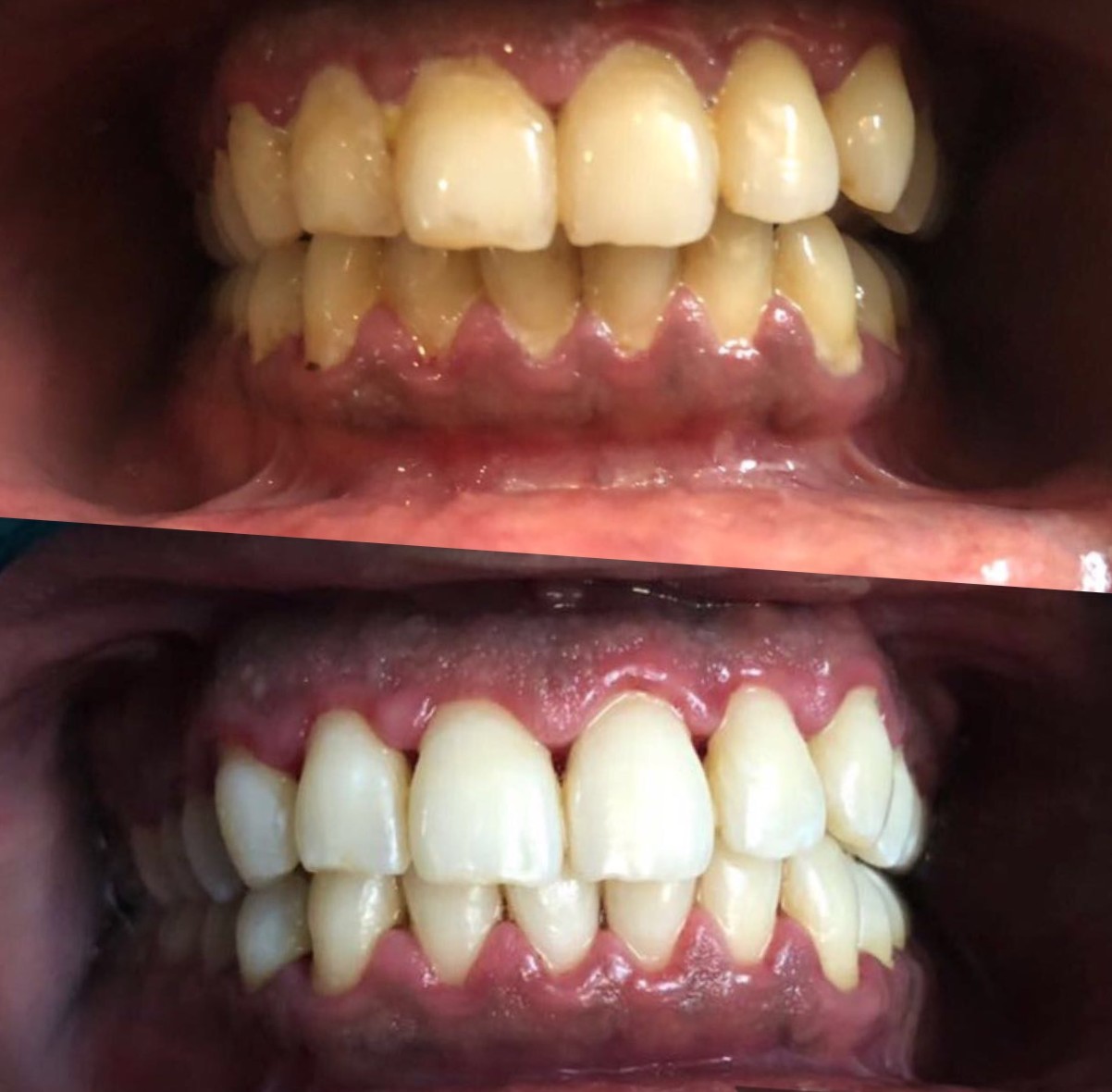 Instant Teeth Whitening